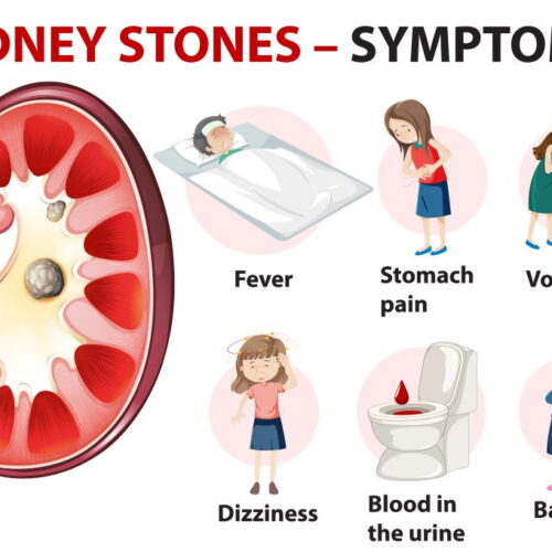 kidney stones - symptoms