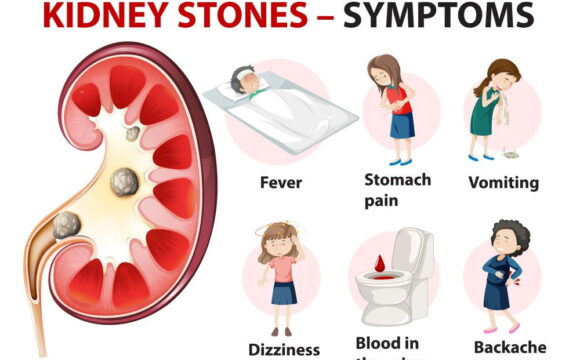 kidney stones - symptoms