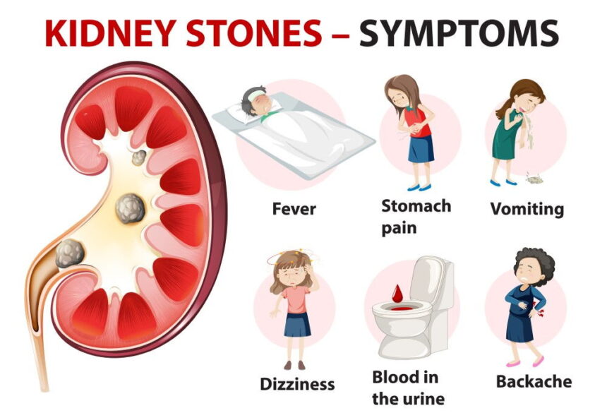 kidney stones - symptoms