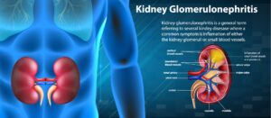 Glomerulonephritis