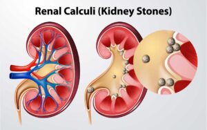 Kidney Stones